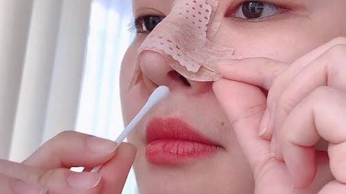 Nâng mũi đã sửa có đau không? Chia sẻ kinh nghiệm nâng mũi lần 2 3