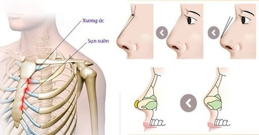 TOP 9 Loại Sụn Nâng Mũi Phổ Biến TỐT NHẤT Hiện Nay 8