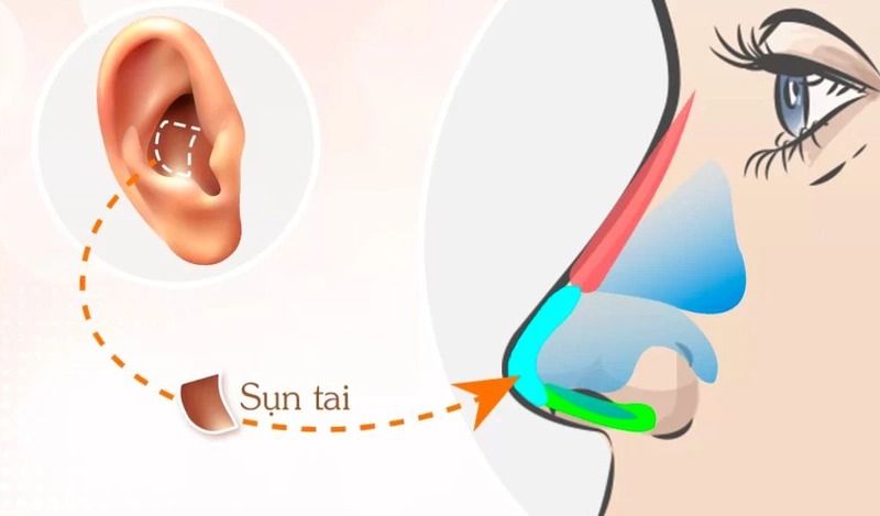 TOP 9 Loại Sụn Nâng Mũi Phổ Biến TỐT NHẤT Hiện Nay 9