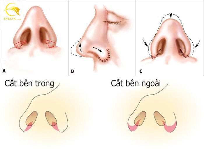 Cắt cánh mũi bao lâu thì lành, đẹp? Giải đáp cùng chuyên gia 3