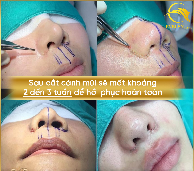 Cắt cánh mũi bao lâu thì lành, đẹp? Giải đáp cùng chuyên gia 2