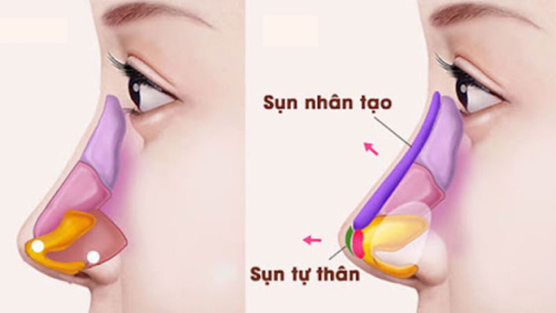 Da mũi mỏng có nâng mũi được không? Phương pháp nâng mũi phù hợp 4